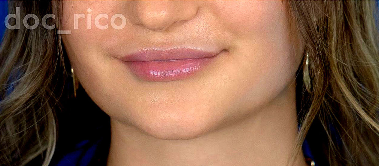 Neposredno nakon prvog tretmana Visage Hyaluron Penom s 1,1 ml