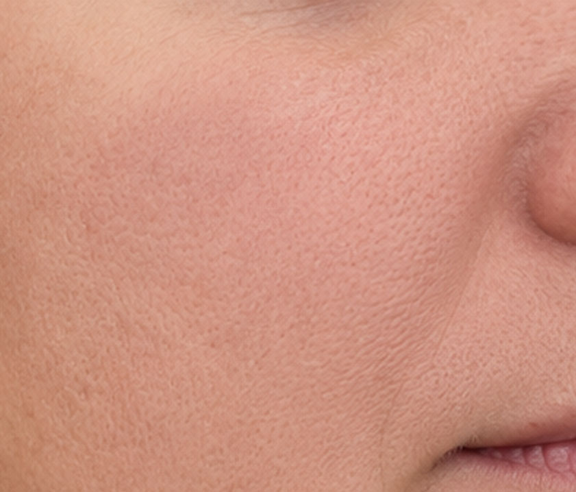 Rezultat prije i poslije u studiju Visage Cosmetic Prije